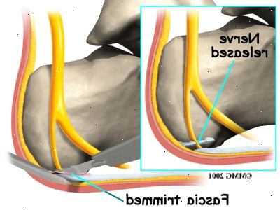 Plantar fasciitis: skal jeg have opereret for smerter i hælen?