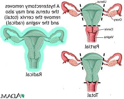 Hysterektomi endometriose