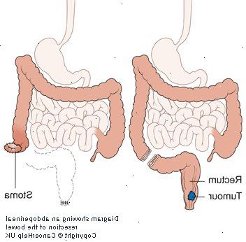 Kirurgi for colon og rektal cancer