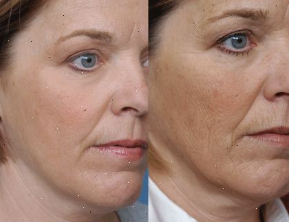 Hvordan laser skin resurfacing værker